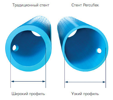 Мочеточниковый стент Boston Scientific Polaris Loop